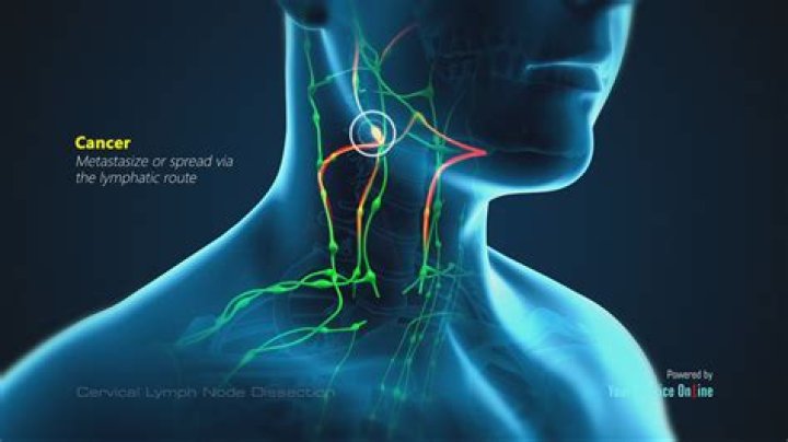 Are cancerous lymph nodes hard or soft?