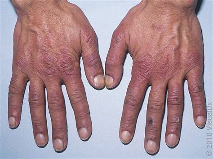Are chilblains?