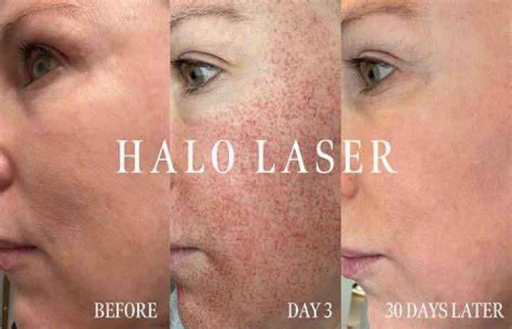 Are Halo results permanent?