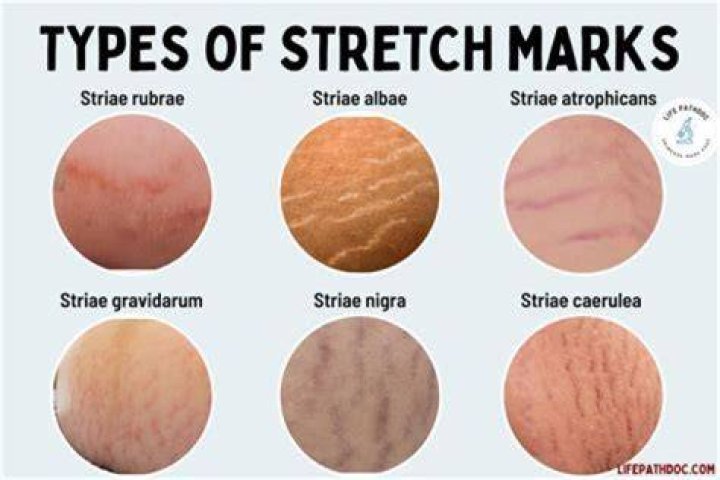 Are iron marks permanent?