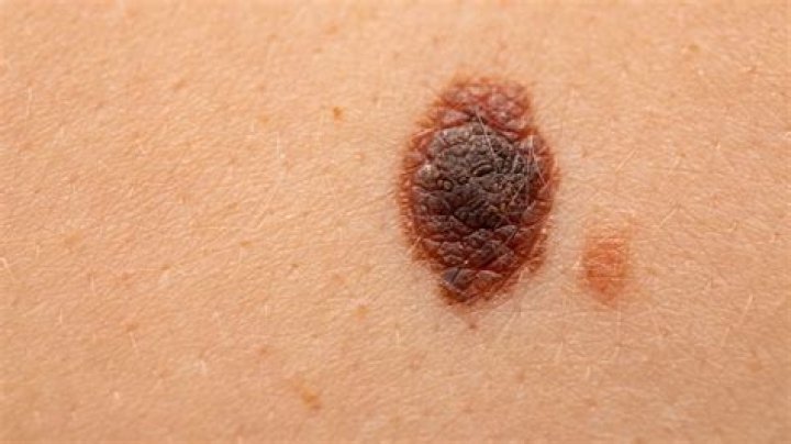 Are melanomas raised?