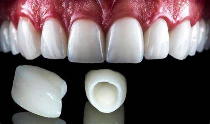 Are porcelain and ceramic crowns the same?