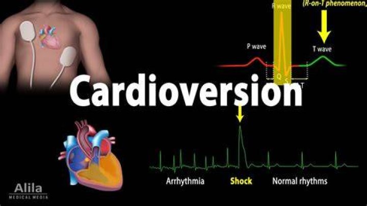 Are you awake during cardioversion?