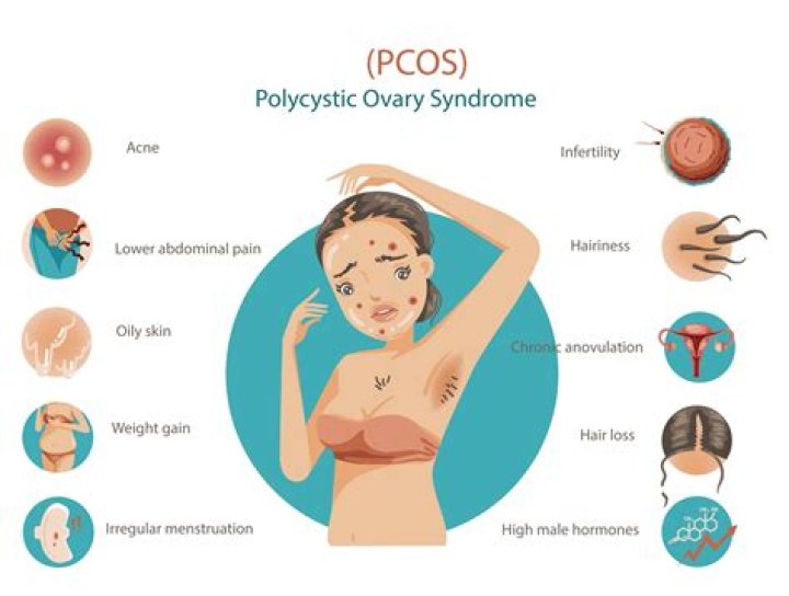 At what age PCOS starts?
