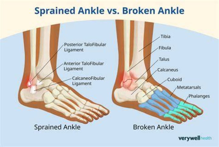 Can a broken ankle cause permanent damage?