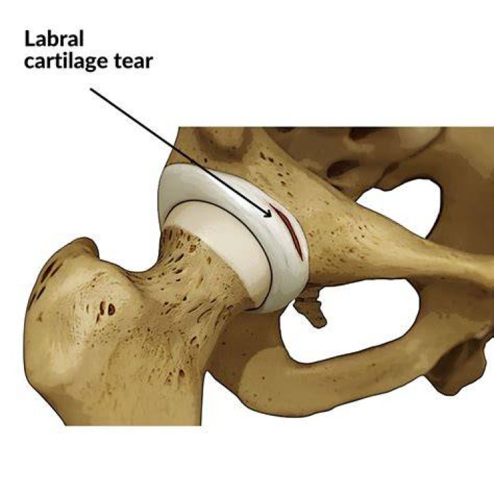 Can a car accident cause a labral tear?