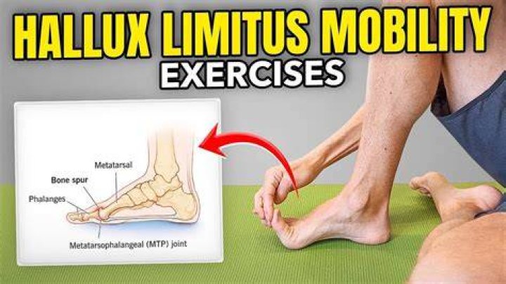 Can a chiropractor help hallux rigidus?