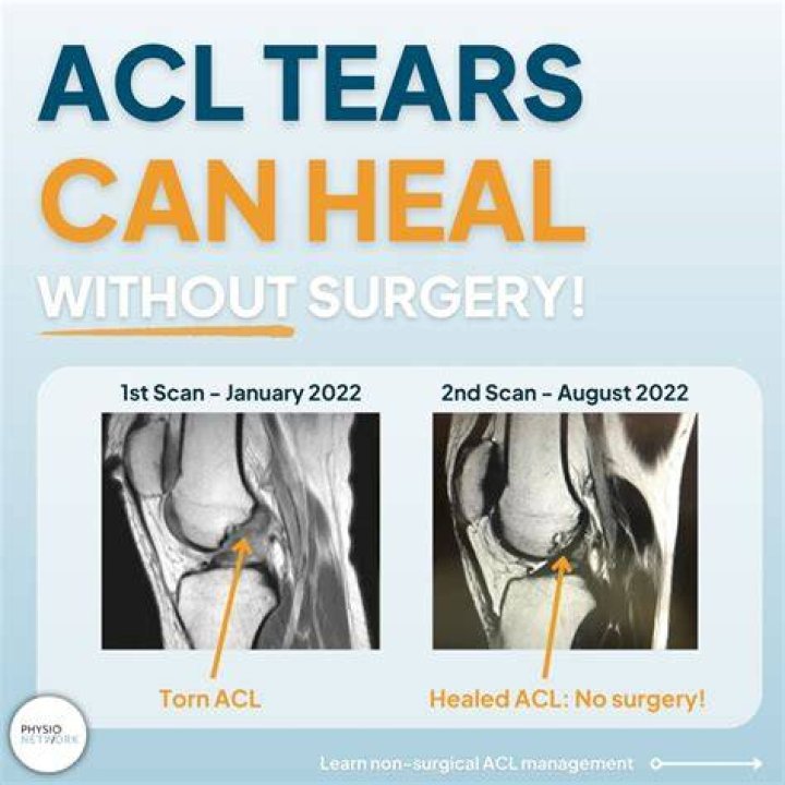 Can a Grade 3 ACL tear heal without surgery?