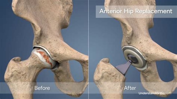 Can a hip replacement last 40 years?