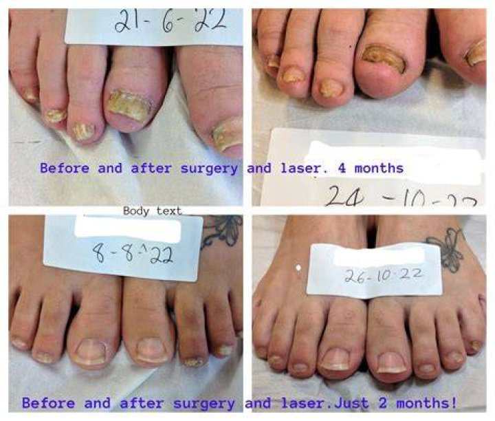 Can a toenail grow back?