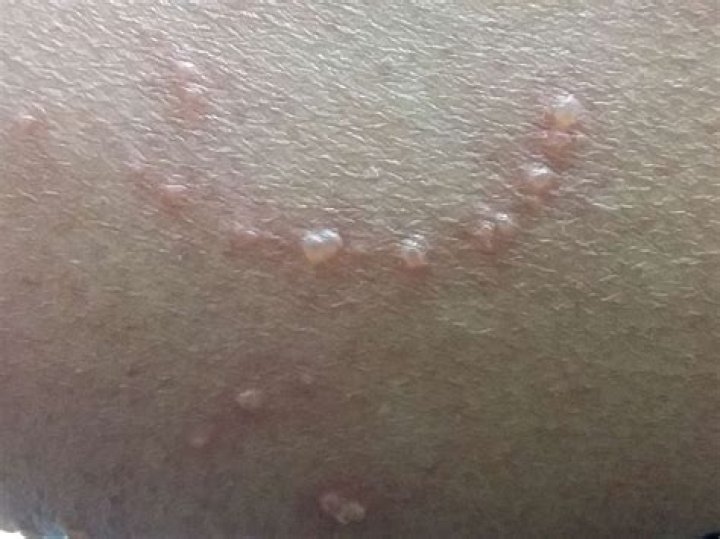 Can a virus cause bumps on skin?