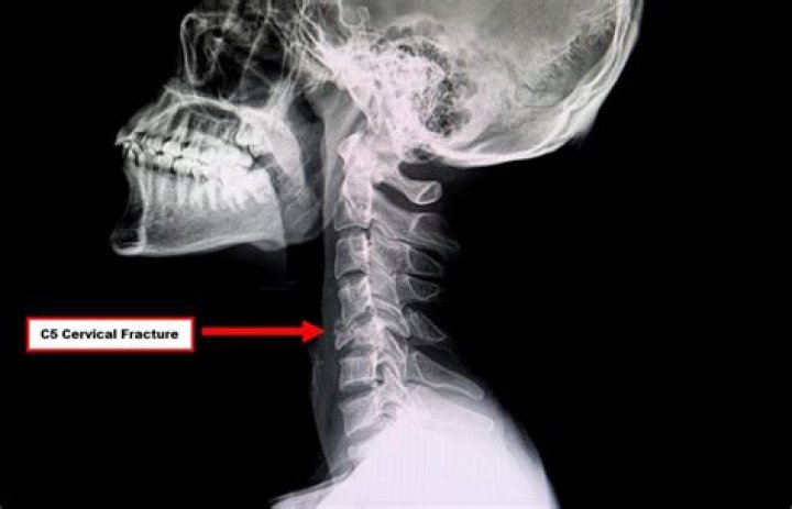 Can a wave break your neck?