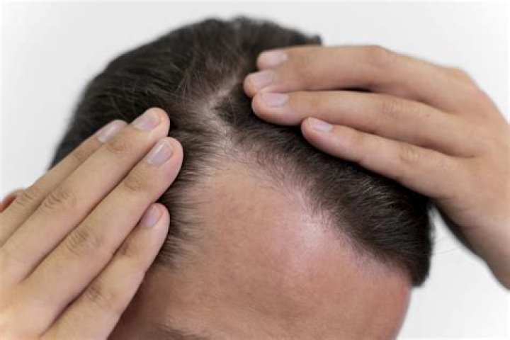 Can aloe cause hair loss?