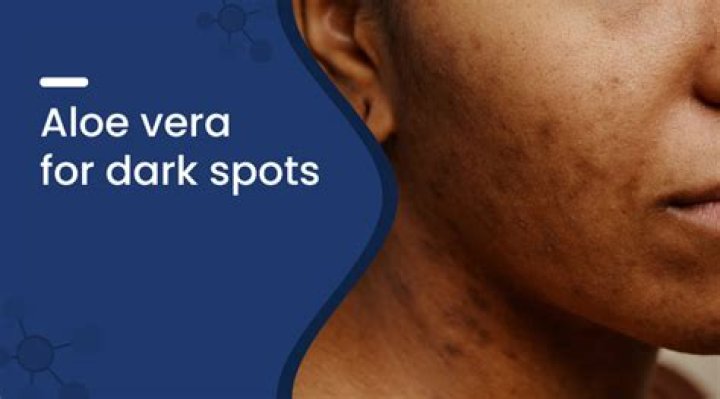 Can aloe vera clear dark spots?