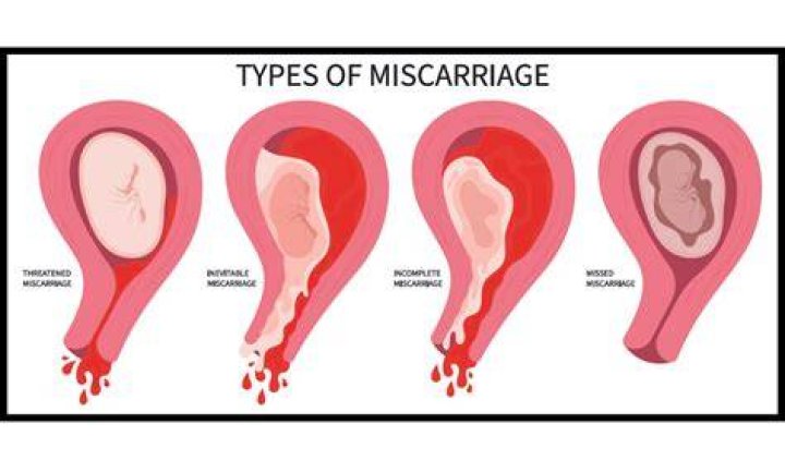Can an ultrasound be wrong about miscarriage?