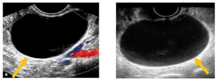 Can an ultrasound detect cystitis?