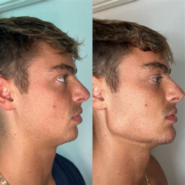 Can anyone develop a jawline?