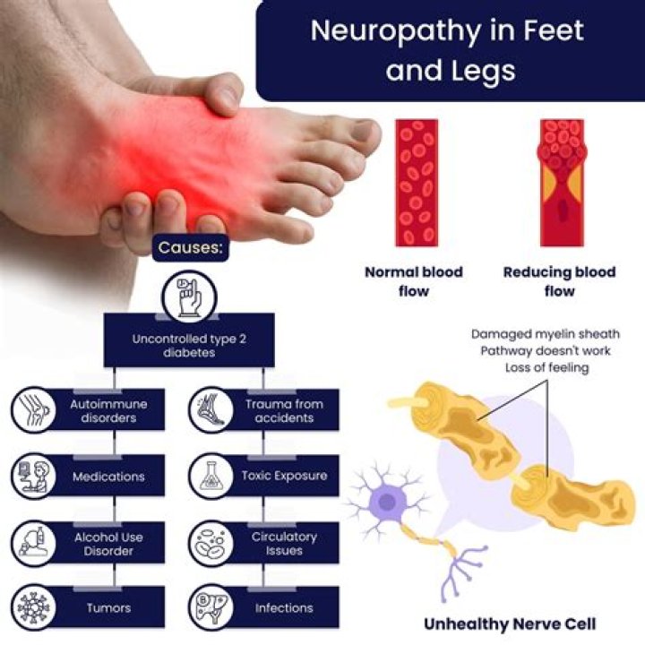 Can arthritis in feet cause neuropathy?