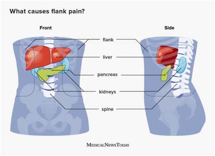 Can bowel problems cause flank pain?