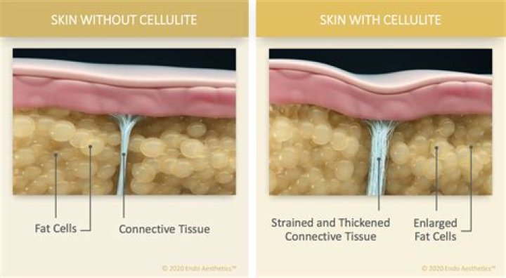 Can cellulite go away?