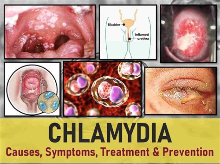 Can chlamydia come back on it's own after being treated?