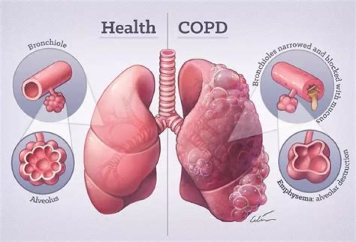 Can COPD go away?