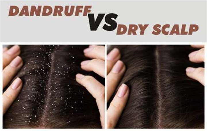 Can dandruff be yellow and hard?