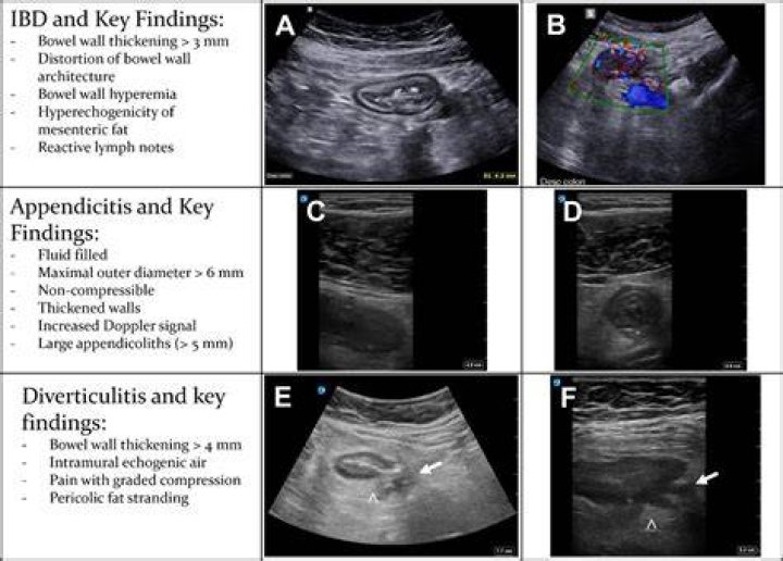 Can diverticulitis be seen on ultrasound?