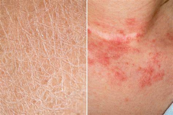 Can dry skin get infected?