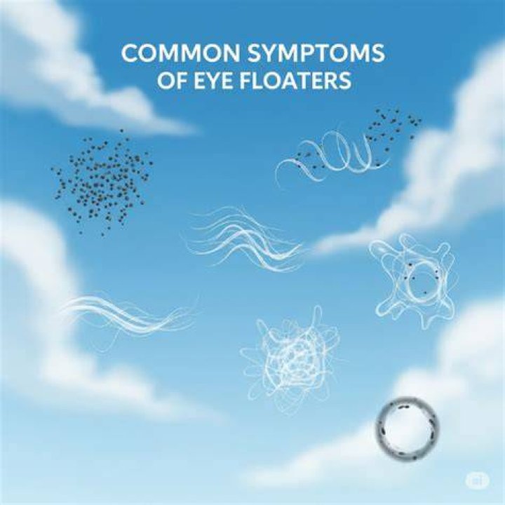 Can floaters appear suddenly?