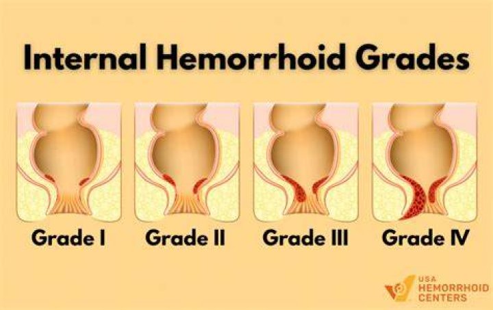 Can Grade 3 hemorrhoids go away on their own?