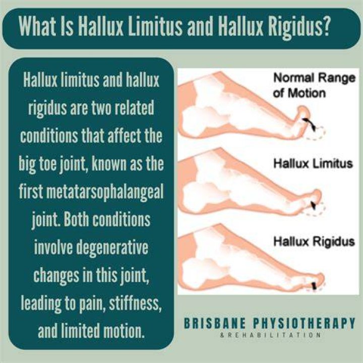 Can hallux rigidus cause other problems?