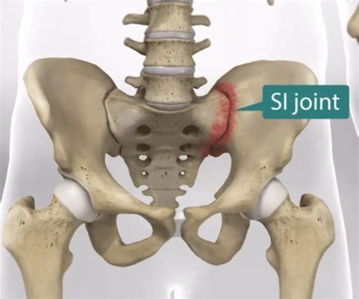 Can hip dysplasia cause SI joint pain?