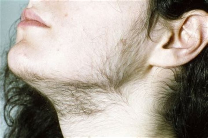 Can hirsutism be normal?