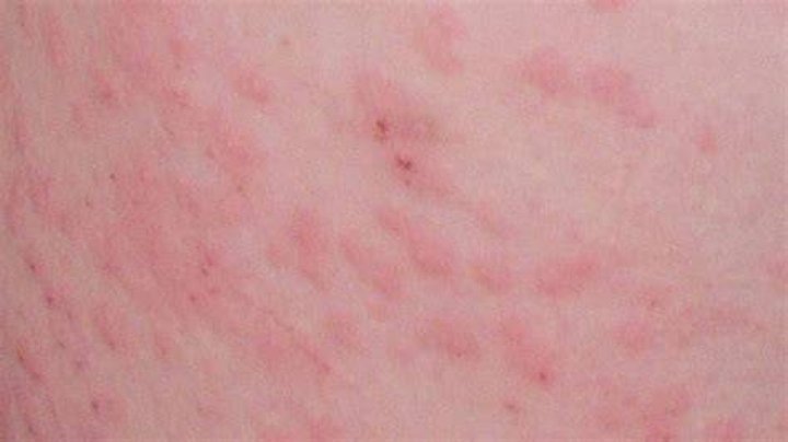 Can histoplasmosis be cured?