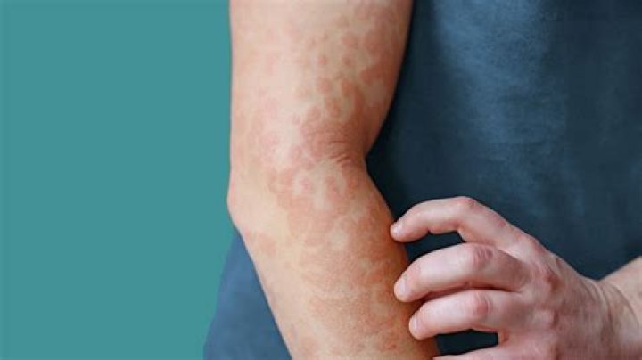 Can hives be a symptom of a virus?