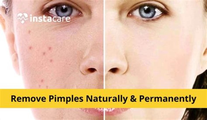 Can honey and lemon remove pimples?