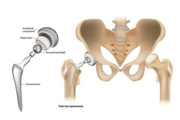 Can I avoid a hip replacement?