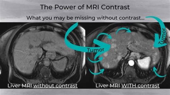 Can I drive after MRI with contrast?