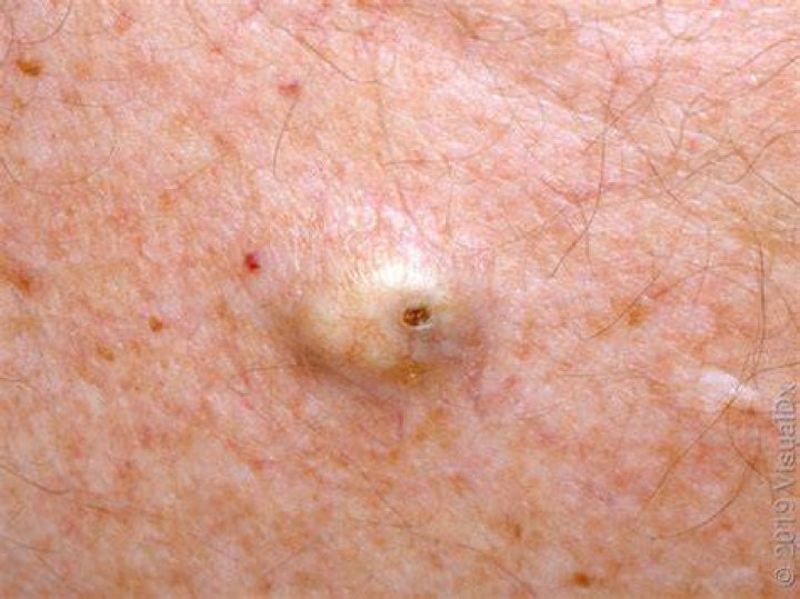 Can I stick a needle in a sebaceous cyst?