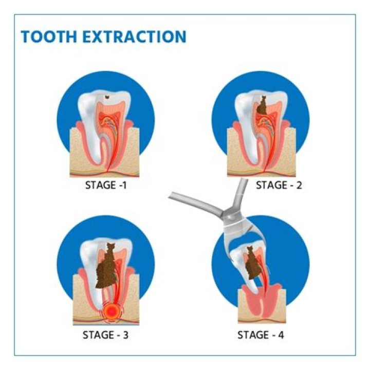 Can I talk after tooth extraction?