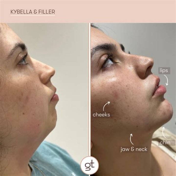 Can Kybella go wrong?