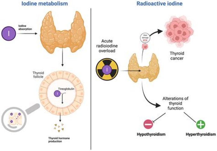 Can lugol's iodine cause hypothyroidism?