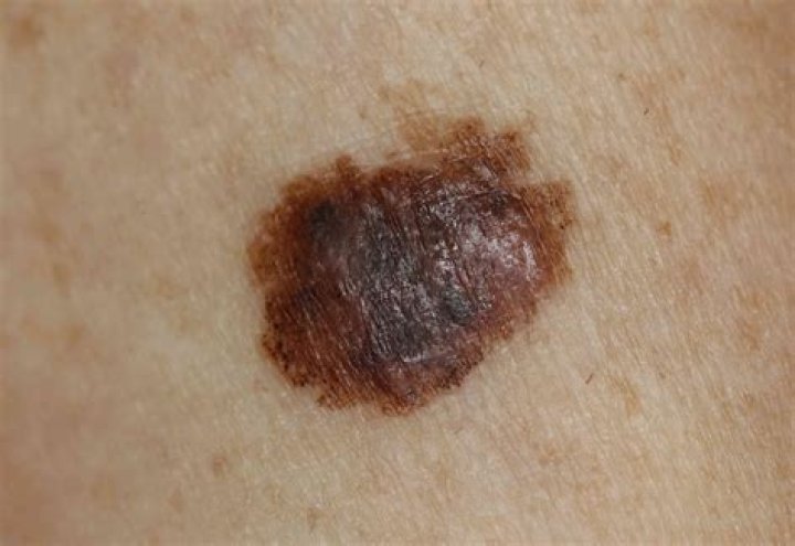 Can melanoma be crusty?