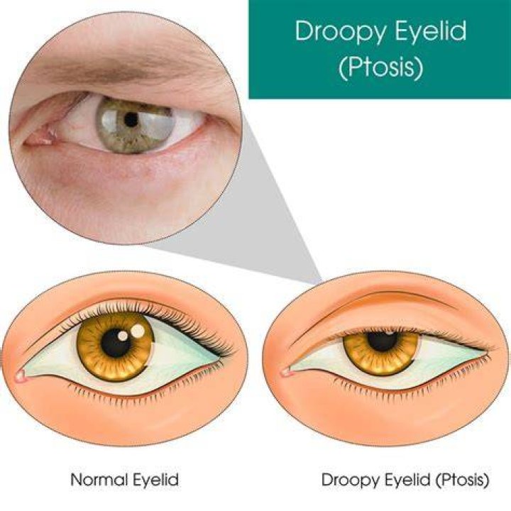 Can MS cause droopy eyelids?