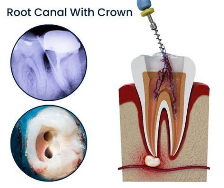 Can root canal be done in one visit?