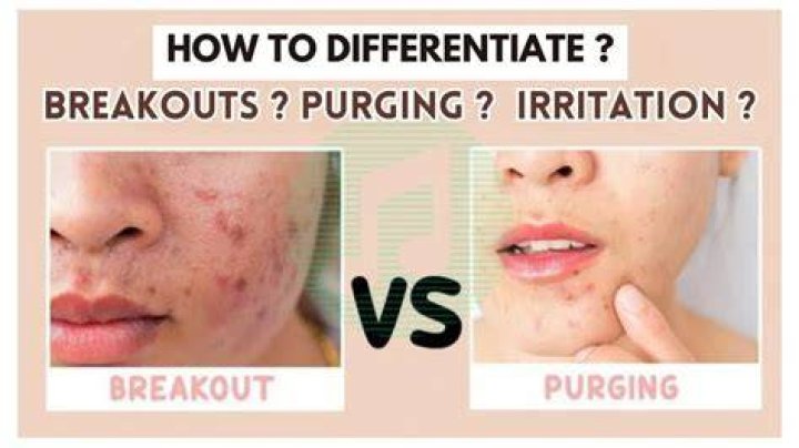 Can skin purging be itchy?
