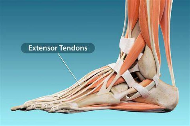Can tendonitis come on suddenly?