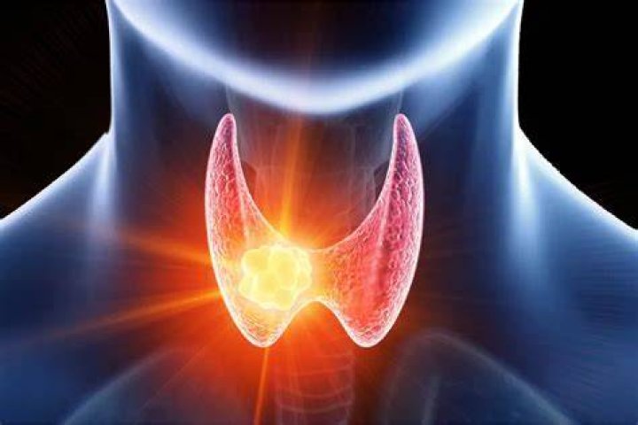 Can thyroid cause headaches?