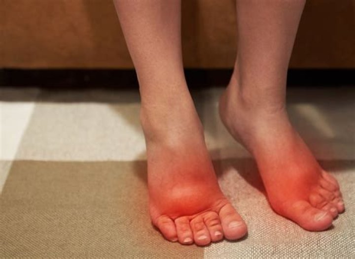Can tight shoes cause swollen feet?